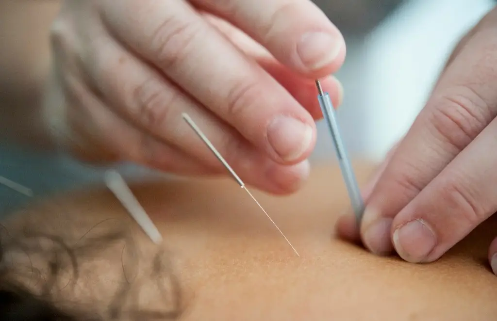 Acupuncture care at Darren Rose Acupuncture and Wellness in London