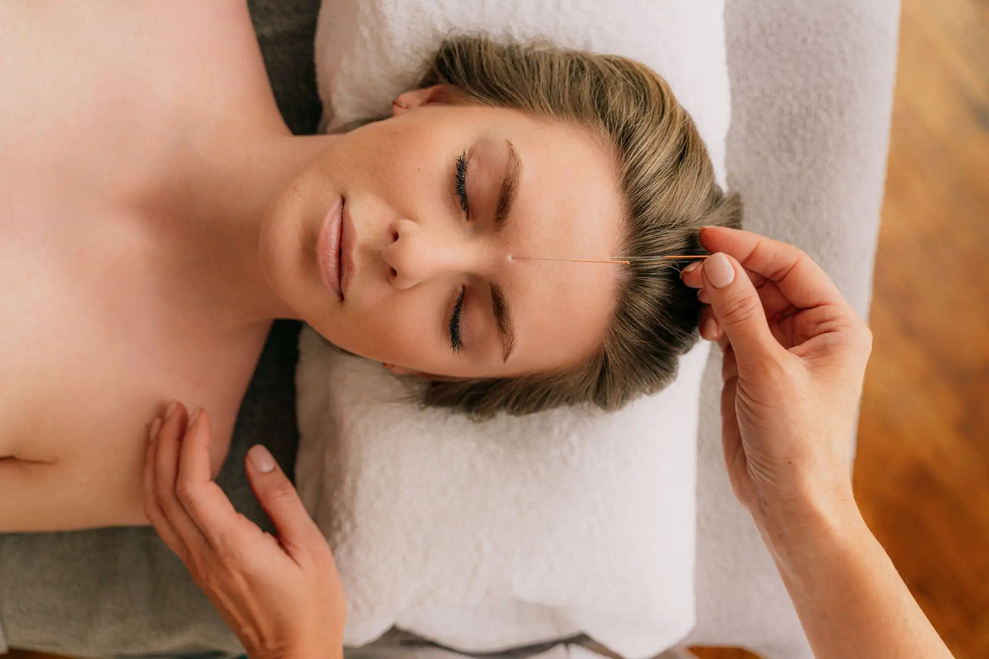 Acupuncture treatment in progress at a calm London clinic